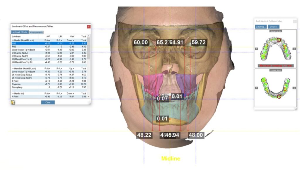 Predicción 3d previa a la cirugía ortognática 